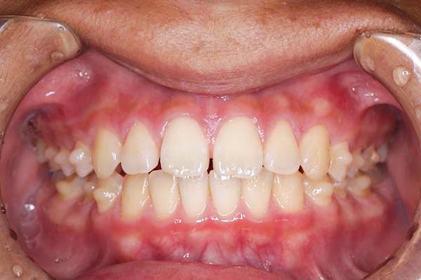 マウスピース矯正イメージ