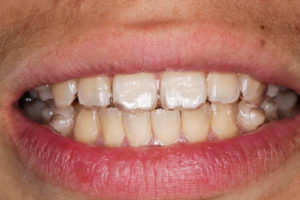 マウスピース矯正装着イメージ