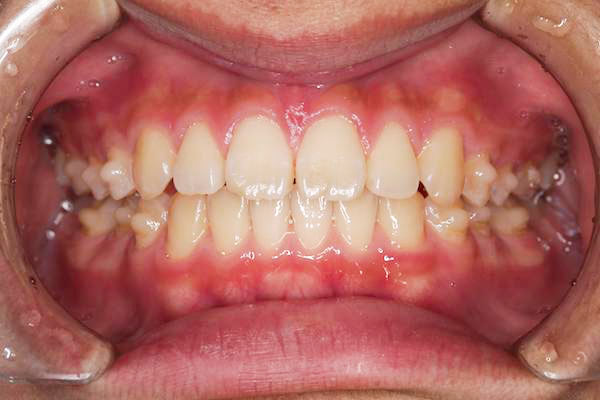 マウスピース矯正開始10週間後イメージ