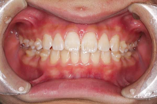 マウスピース矯正開始14週間後イメージ