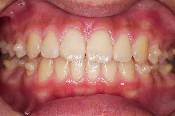 マウスピース矯正開始20週間後イメージ