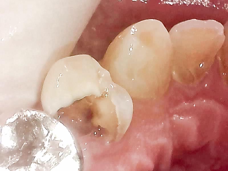 むし歯イメージ