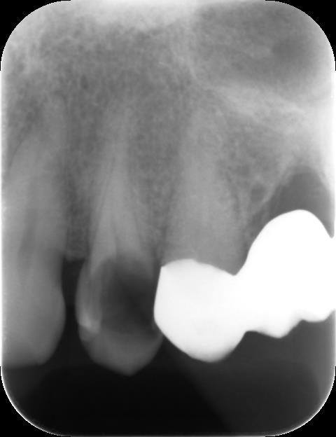 むし歯レントゲンイメージ