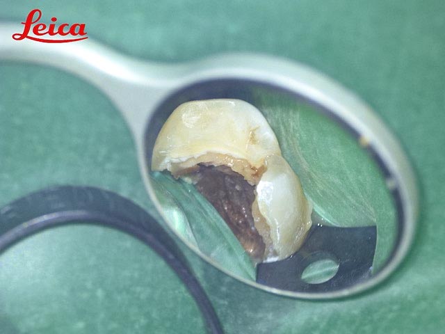 むし歯治療イメージ