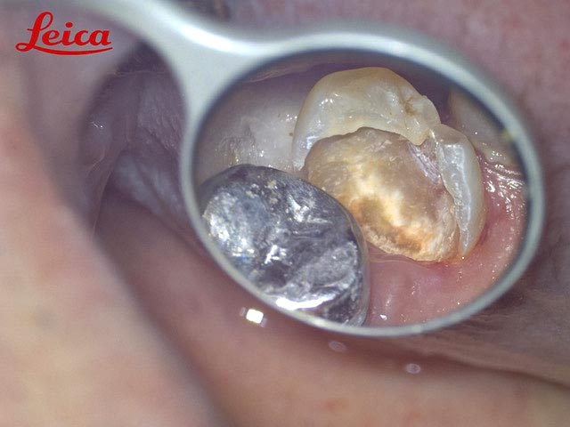 むし歯除去後イメージ