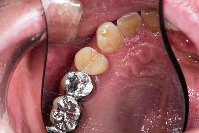 カリソルブ治療後イメージ