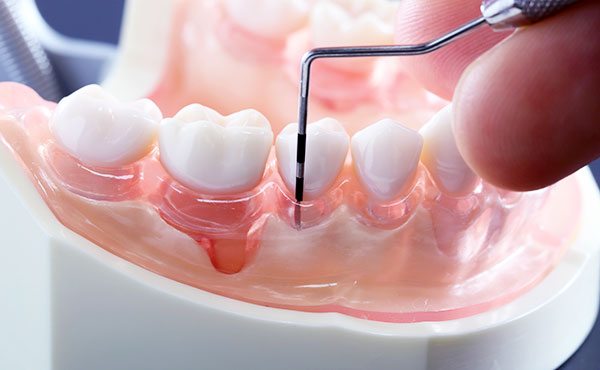 歯周治療のご案内イメージ