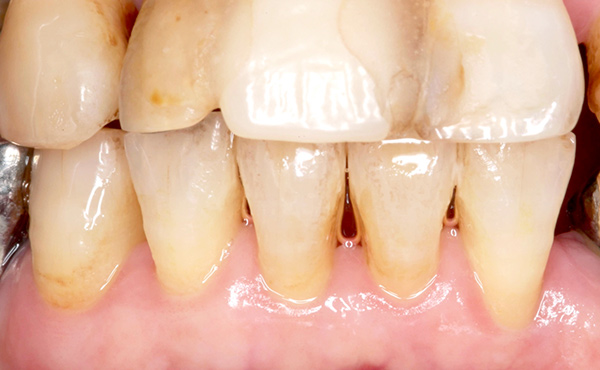歯周治療のイメージ