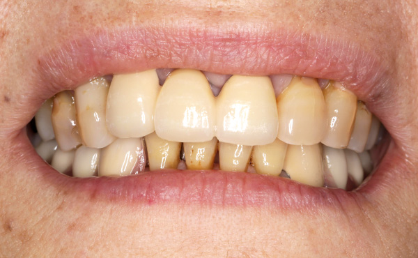 入れ歯イメージ