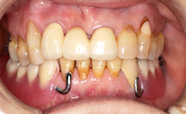 入れ歯イメージ