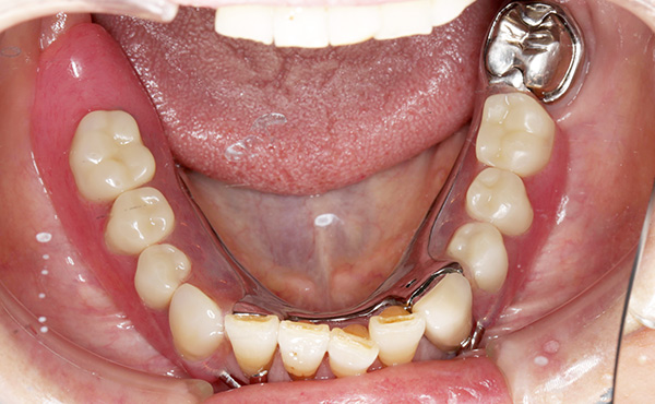 入れ歯イメージ